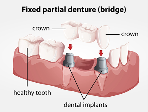 Fixed partial denture bridge on two implants