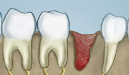 Tooth Socket After Extraction