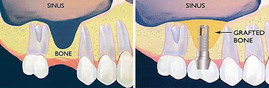 Sinus Lift Bone Graft Adds Bone For A Dental Implant